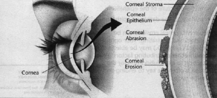 abrasions