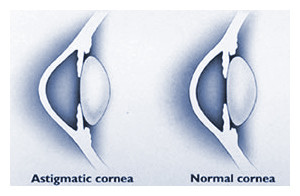 astigmatismcorrec